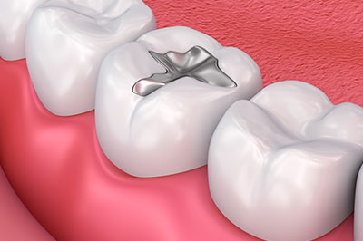 Cass Street Dental Office | Dental Bridges, Veneers and Teeth Whitening