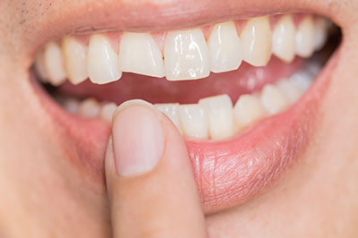 Cass Street Dental Office | Dental Fillings, Teeth Whitening and Preventative Program