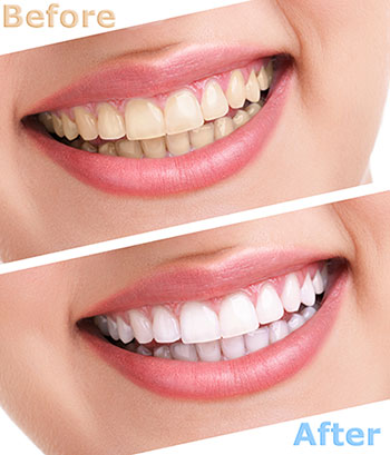 Cass Street Dental Office | Dental Bridges, Veneers and Preventative Program